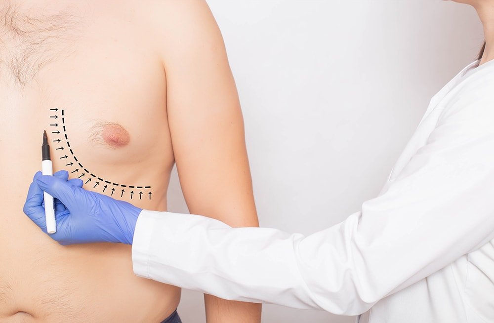 Gynecomastia male breast enlargement — male breast reduction candidacy Luxxery Waldorf MD