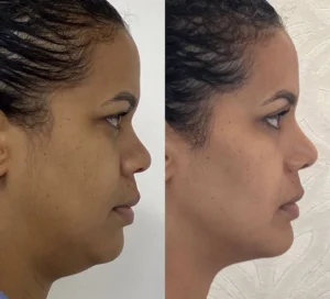 neck lift before and after