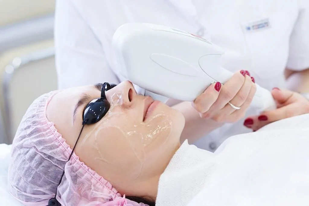 IPL Therapy for Sun Damage