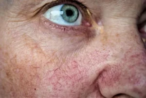 close up facial vein