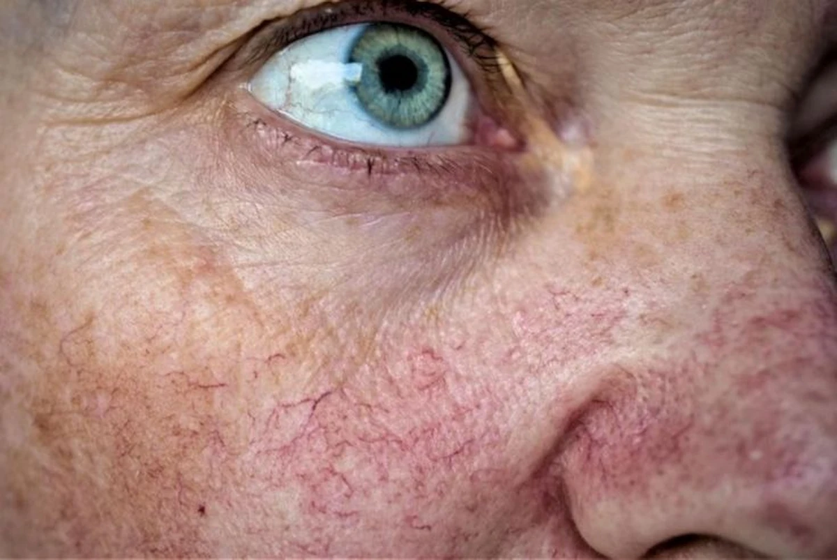 Facial Vein Therapy: Spider Vein Treatment