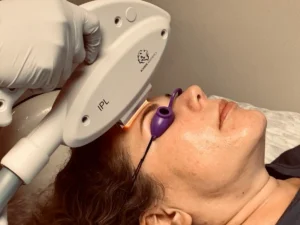 IPL therapy / facial rejuvenation