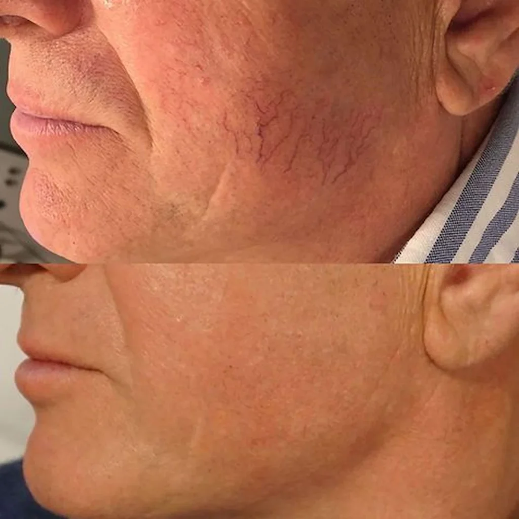 Facial Vein Therapy: Spider Vein Treatment