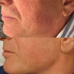 before and after facial vein treatment