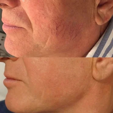 before and after facial vein treatment