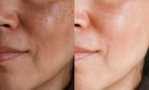 sun damage dark spots