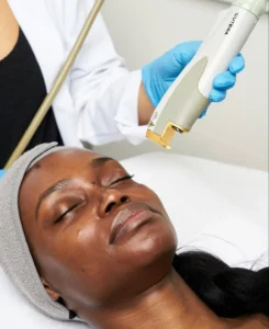IPL therapy 