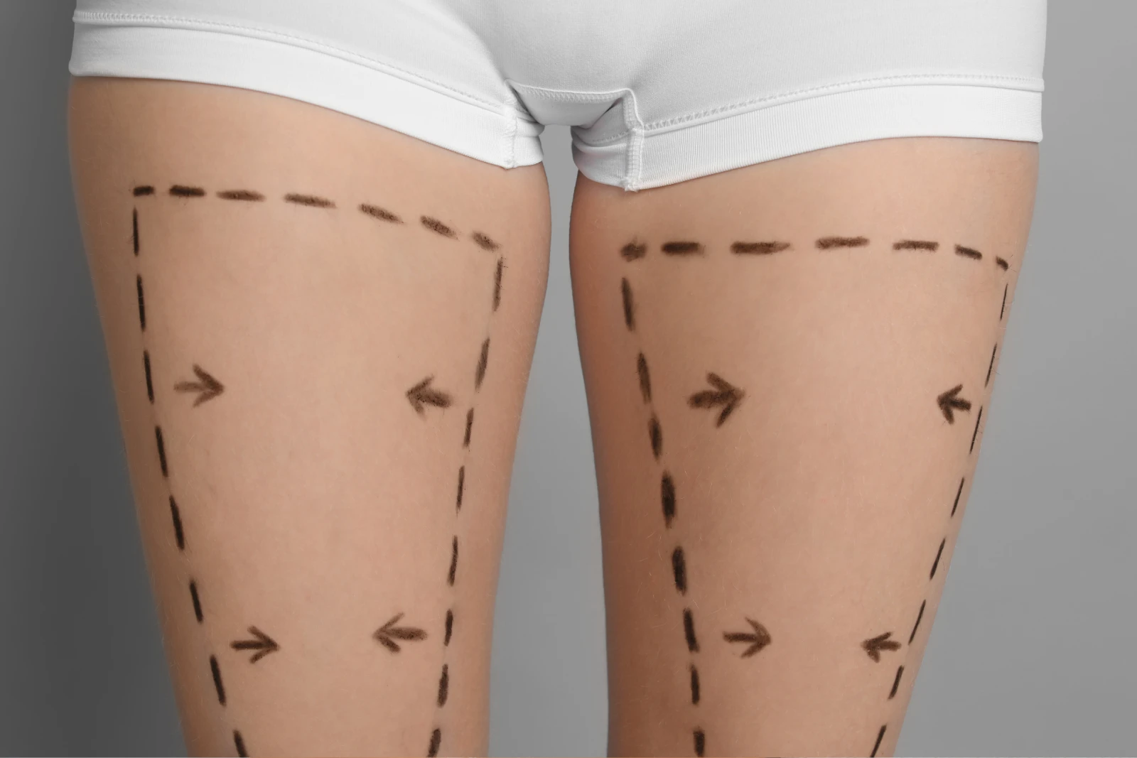 Thigh lift thighplasty surgery Luxxery Waldorf MD