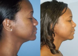 Luxxery rhinoplasty patient before on the left and after on the right, shown from a side-profile view.