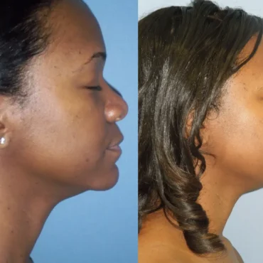 Luxxery rhinoplasty patient before on the left and after on the right, shown from a side-profile view.