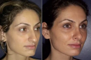 Luxxery rhinoplasty patient before on the left and after on the right, shown from a three-quarter facial view.